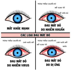 chuẩn đoán bệnh đau mắt đỏ