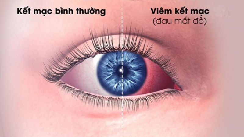 bệnh đau mắt đỏ lây qua đường nào