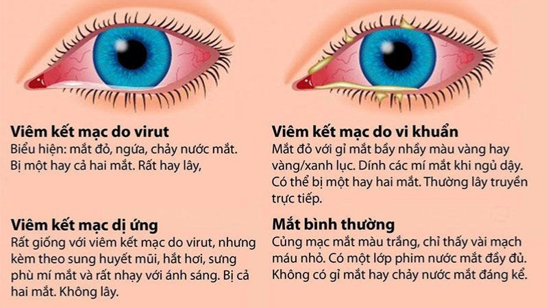 bệnh đau mắt đỏ ở trẻ em