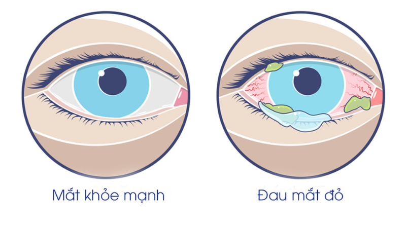 cách phòng bệnh đau mắt đỏ ở trẻ em