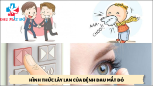 hình thức lây lan của bệnh đau mắt đỏ