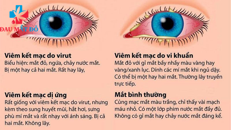 hình thức lây lan của bệnh đau mắt đỏ