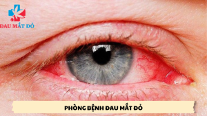 Phòng bệnh đau mắt đỏ