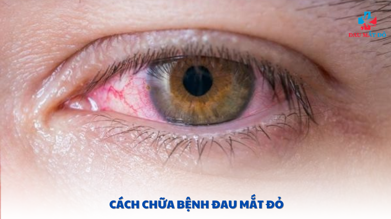 cách chữa bệnh đau mắt đỏ