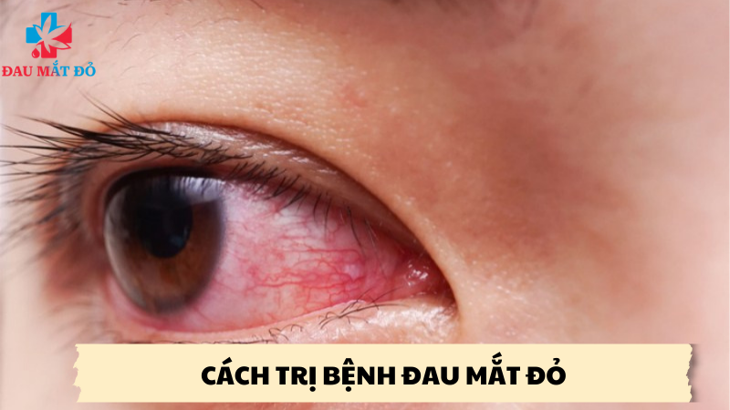 cách trị bệnh đau mắt đỏ