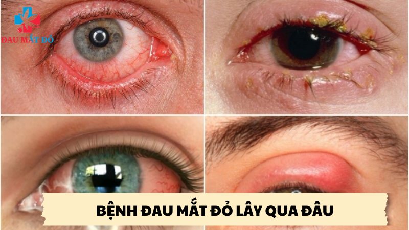 bệnh đau mắt đỏ lây qua đâu